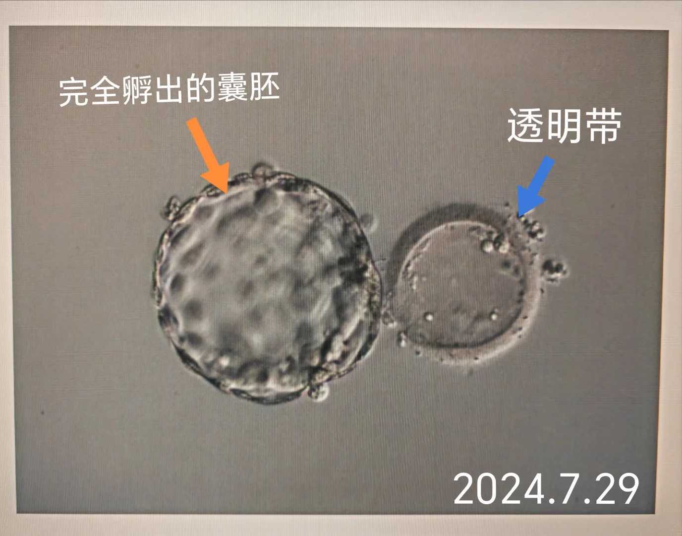  避开遗传病风险，三代试管技术的科学解析